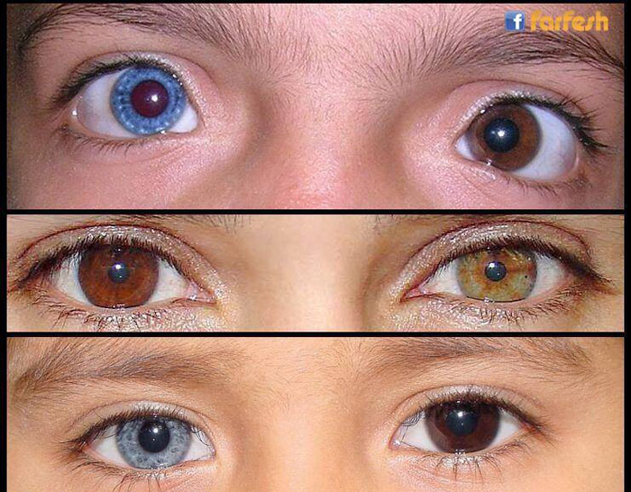               (Heterochromia)